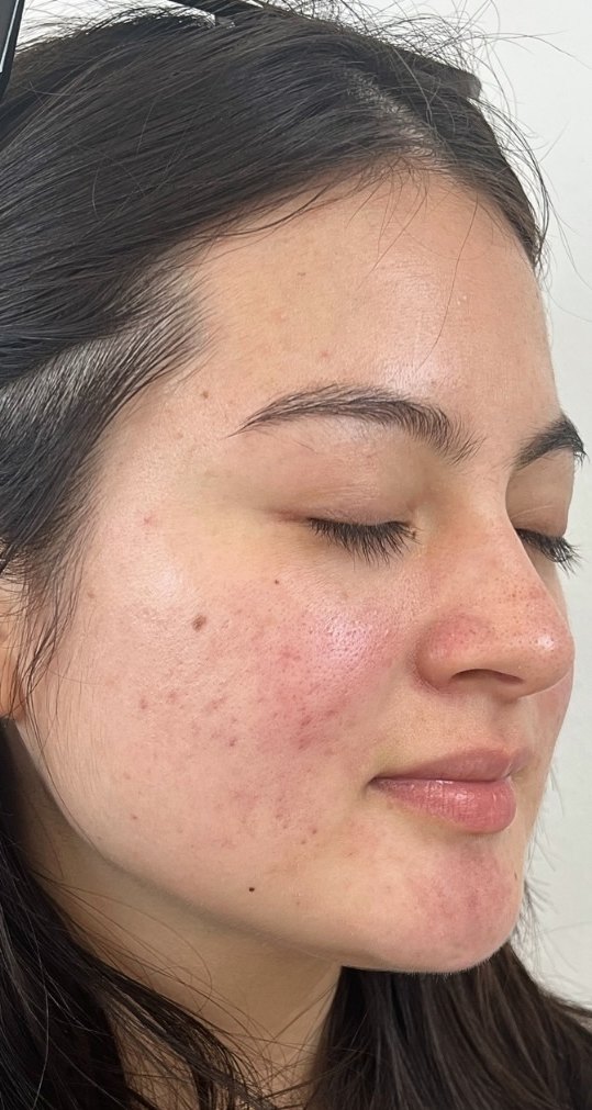 Client 10, face, after treatment