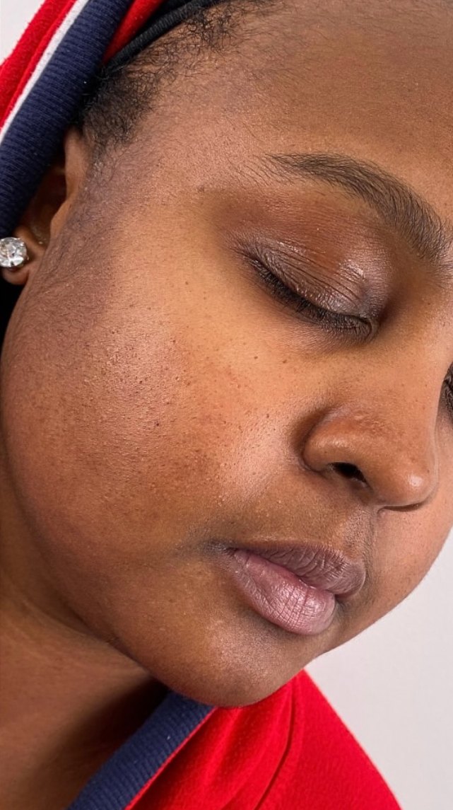 Client 11, face, after treatment