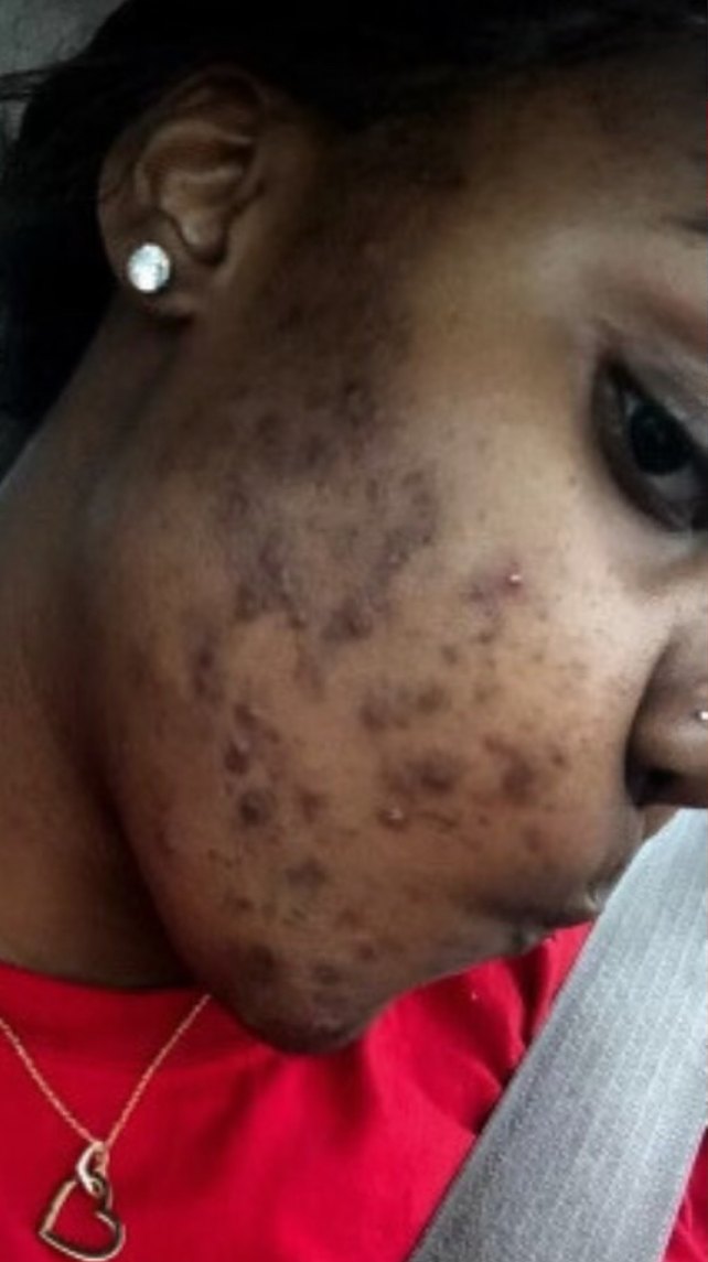 Client 11, face, before treatment