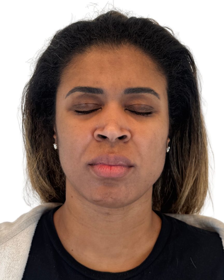Client 02, face, after treatment