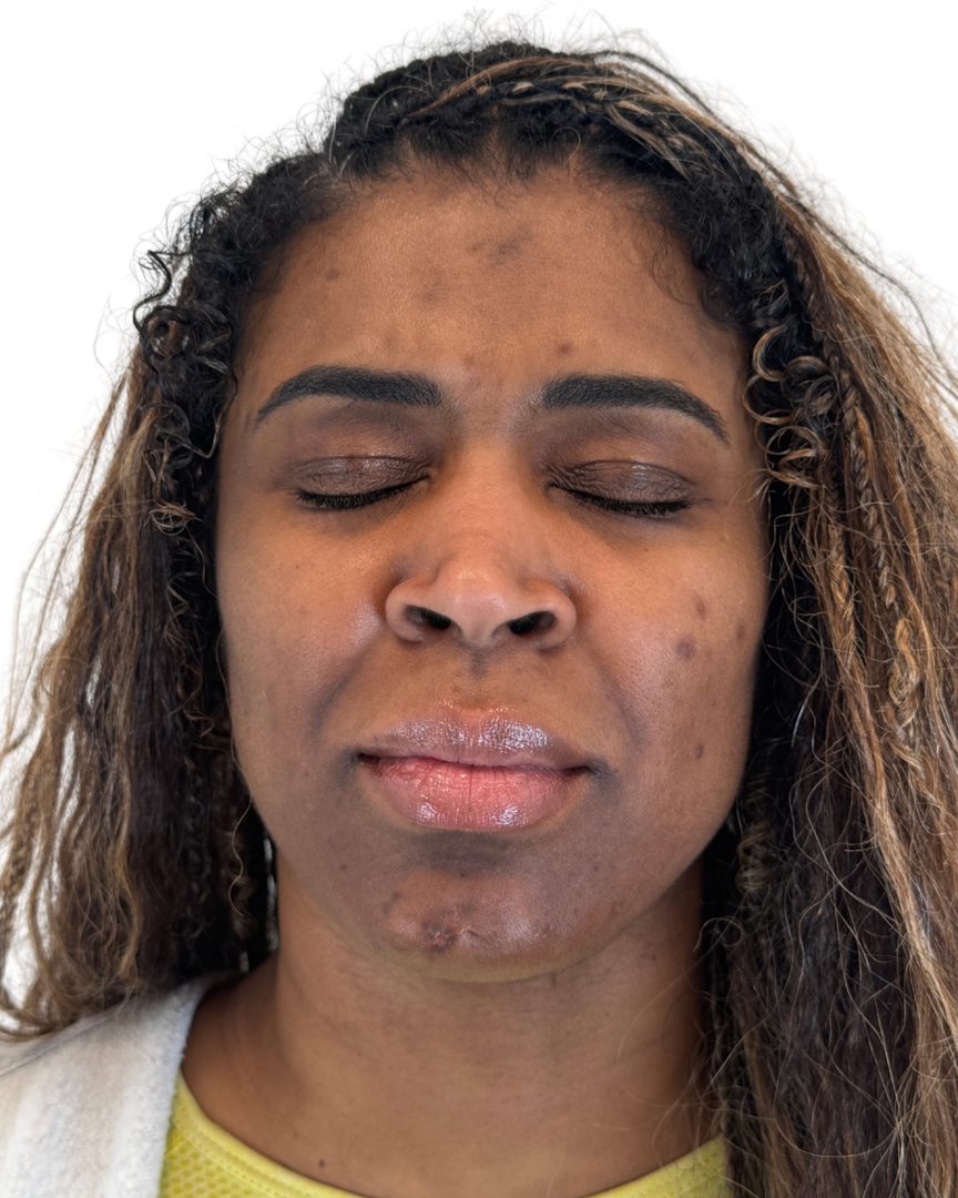 Client 02, face, before treatment