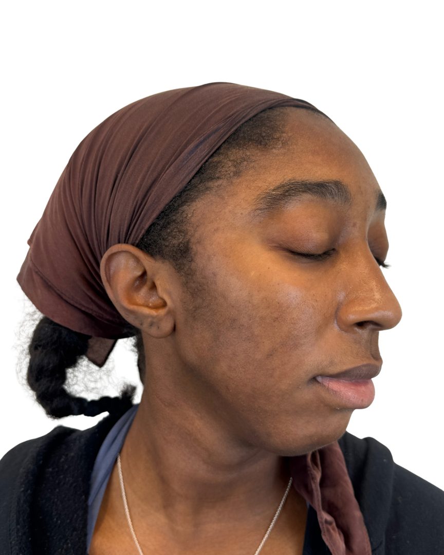 Client 03, face, after treatment