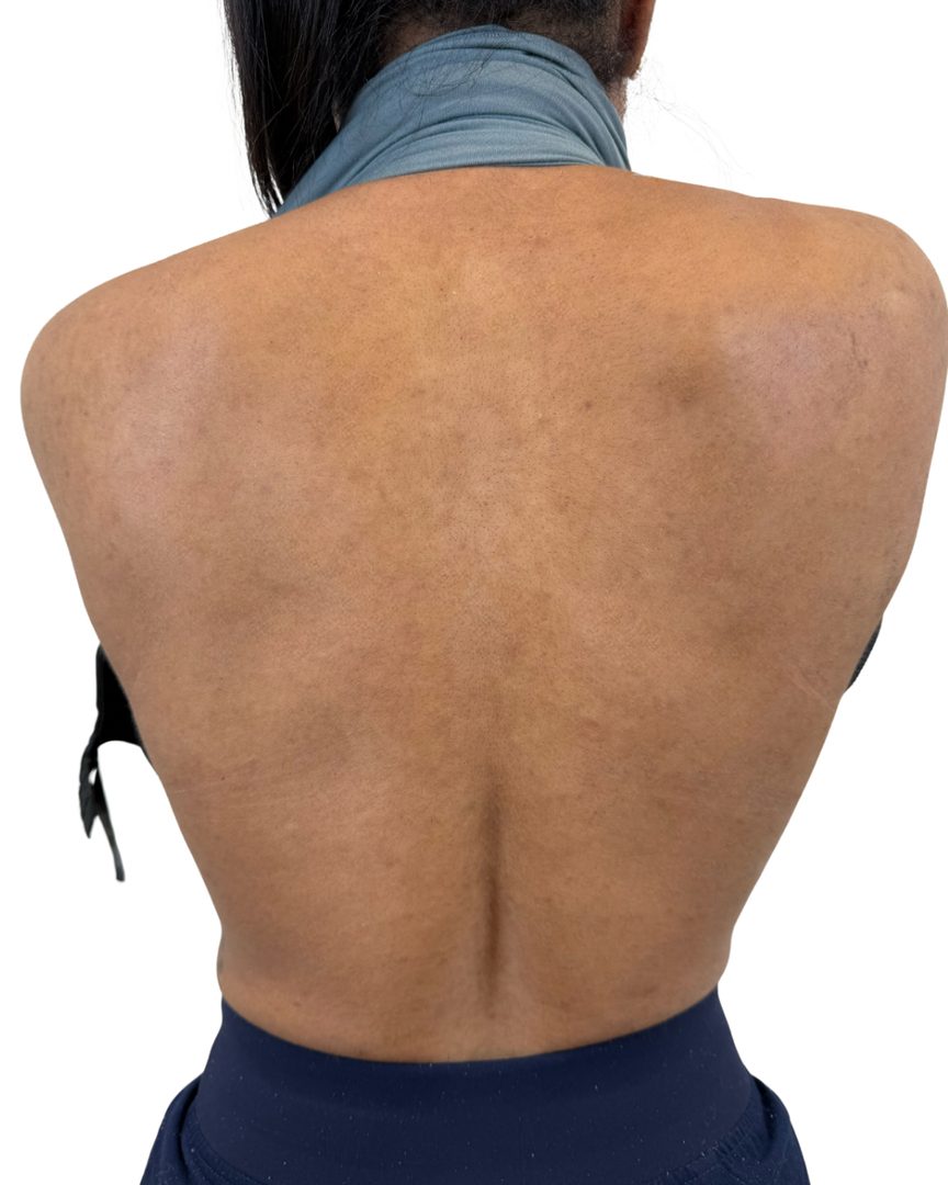 Client 04, back, after treatment