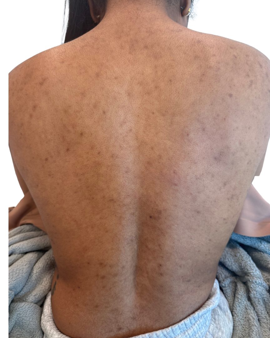 Client 04, back, before treatment