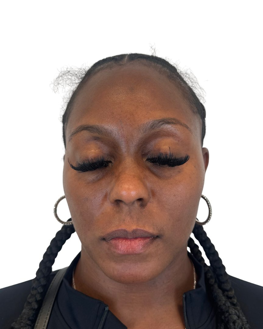 Client 05, face, after treatment