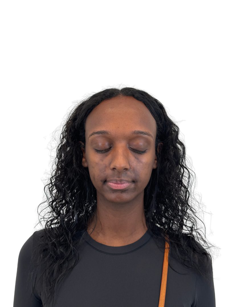 Client 07, face, before treatment