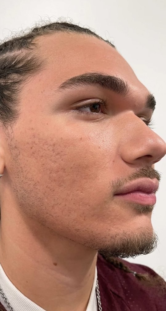 Client 09, face, after treatment