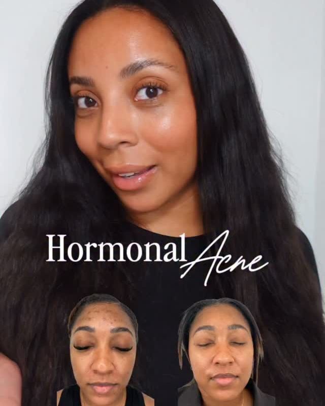 Instagram reel: Treating hormonal acne