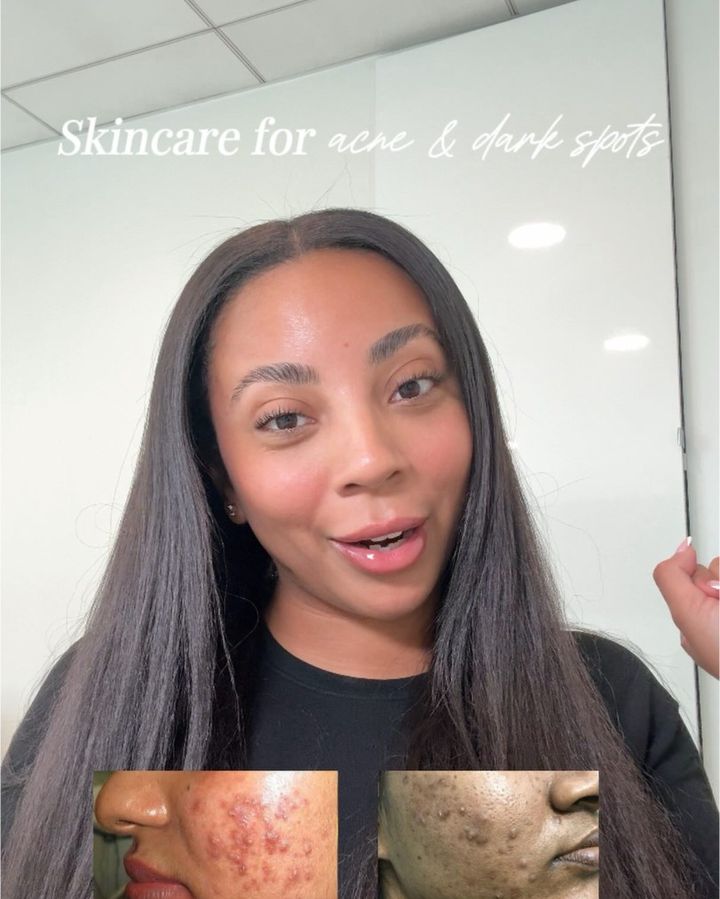 Instagram reel: Azelaic acid for acne and pigment